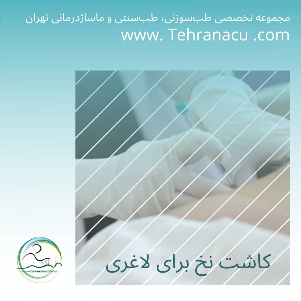 کاشت نخ لاغری